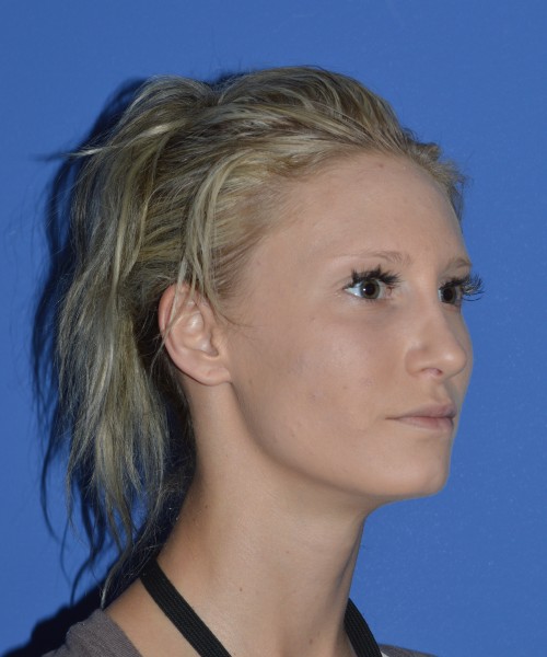 Rhinoplasty 1267 – Click HERE for more views after photo. Individual results may vary.
