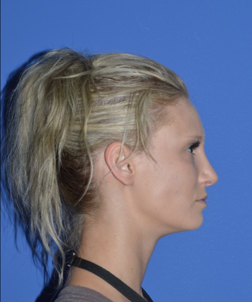 Rhinoplasty 1267 – Click HERE for more views after photo. Individual results may vary.