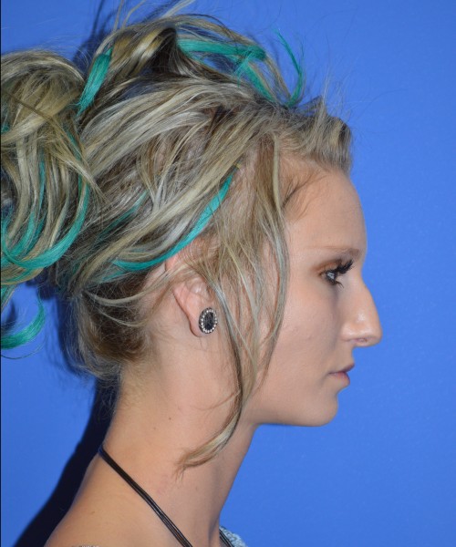 Rhinoplasty 1267 – Click HERE for more views before photo. Individual results may vary.