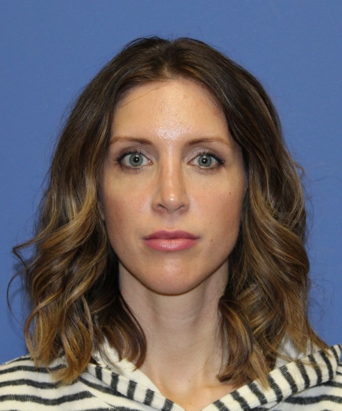 Rhinoplasty 1268 – Click HERE for more views after photo. Individual results may vary.
