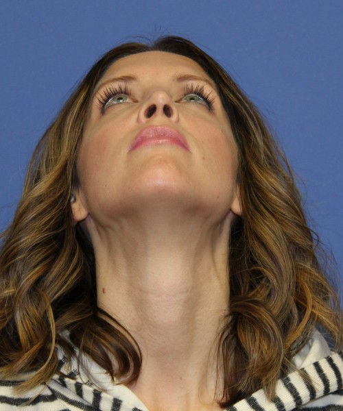 Rhinoplasty 1268 – Click HERE for more views after photo. Individual results may vary.