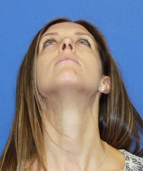 Rhinoplasty 1268 – Click HERE for more views before photo. Individual results may vary.