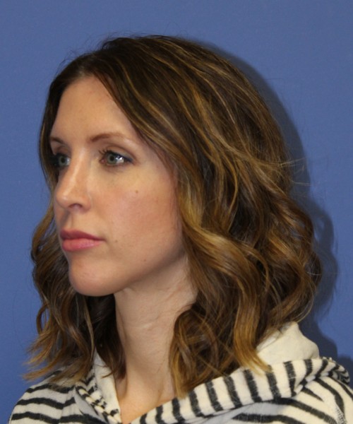 Rhinoplasty 1268 – Click HERE for more views after photo. Individual results may vary.