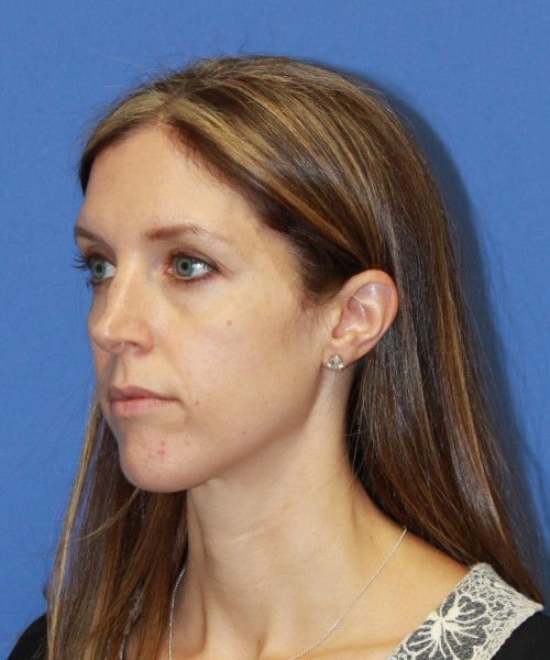 Rhinoplasty 1268 – Click HERE for more views before photo. Individual results may vary.