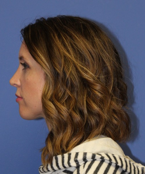 Rhinoplasty 1268 – Click HERE for more views after photo. Individual results may vary.