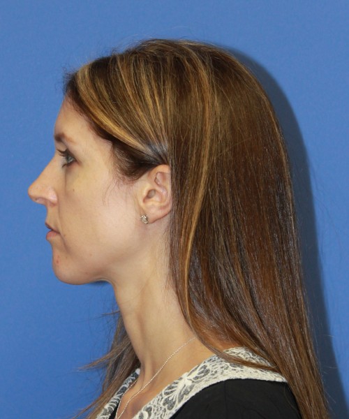 Rhinoplasty 1268 – Click HERE for more views before photo. Individual results may vary.