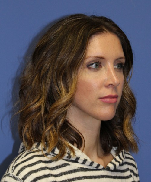Rhinoplasty 1268 – Click HERE for more views after photo. Individual results may vary.
