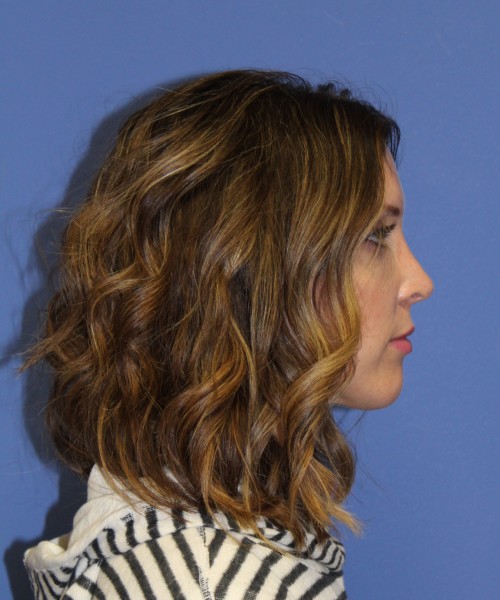 Rhinoplasty 1268 – Click HERE for more views after photo. Individual results may vary.