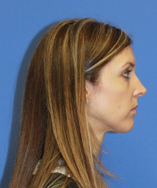 Rhinoplasty 1268 – Click HERE for more views before photo. Individual results may vary.