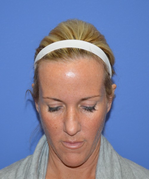 Rhinoplasty 1269 – Click HERE for more views before photo. Individual results may vary.