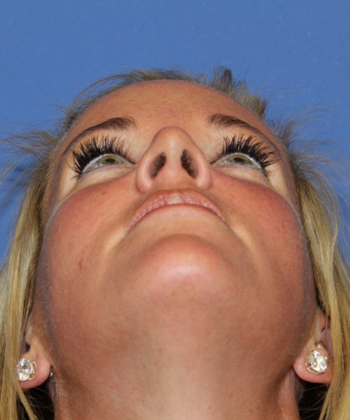 Rhinoplasty 1269 – Click HERE for more views after photo. Individual results may vary.