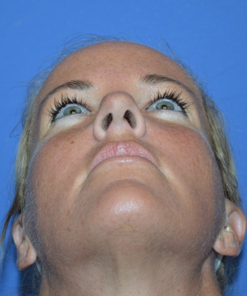 Rhinoplasty 1269 – Click HERE for more views before photo. Individual results may vary.