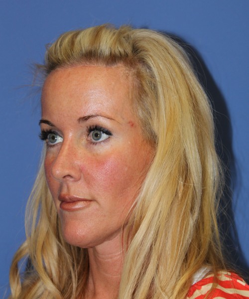 Rhinoplasty 1269 – Click HERE for more views after photo. Individual results may vary.