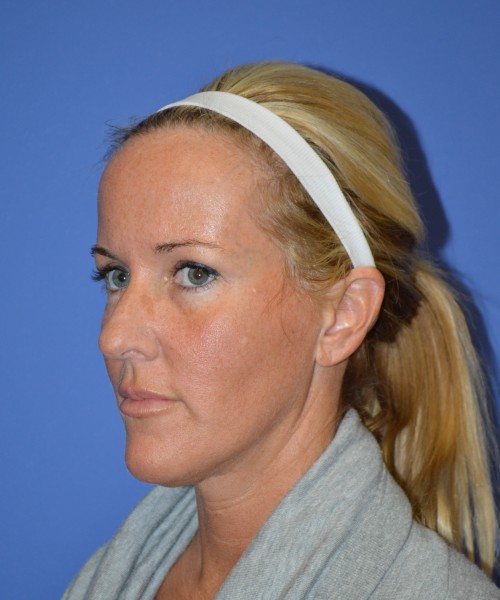 Rhinoplasty 1269 – Click HERE for more views before photo. Individual results may vary.