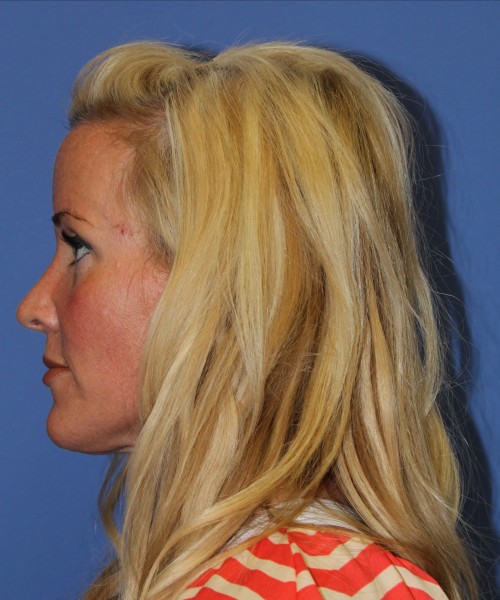 Rhinoplasty 1269 – Click HERE for more views after photo. Individual results may vary.