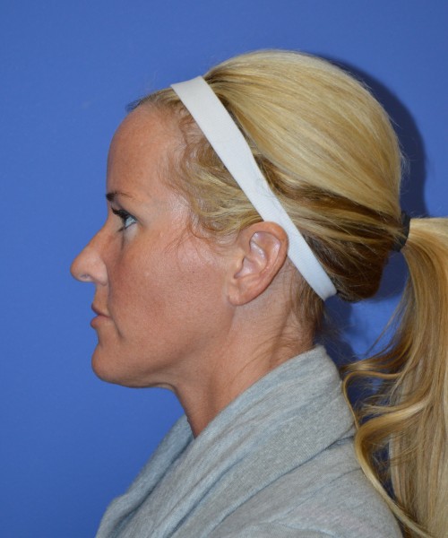 Rhinoplasty 1269 – Click HERE for more views before photo. Individual results may vary.