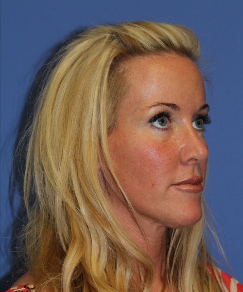 Rhinoplasty 1269 – Click HERE for more views after photo. Individual results may vary.
