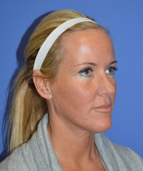 Rhinoplasty 1269 – Click HERE for more views before photo. Individual results may vary.
