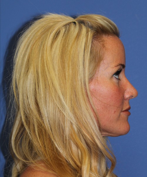 Rhinoplasty 1269 – Click HERE for more views after photo. Individual results may vary.