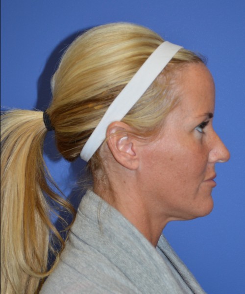 Rhinoplasty 1269 – Click HERE for more views before photo. Individual results may vary.