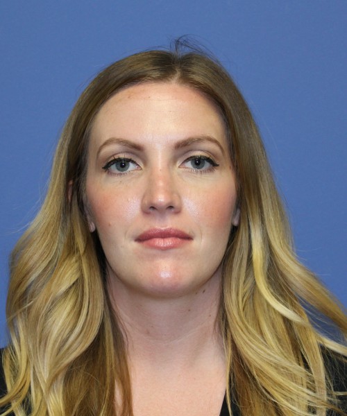 Rhinoplasty 1270 – Click HERE for more views after photo. Individual results may vary.