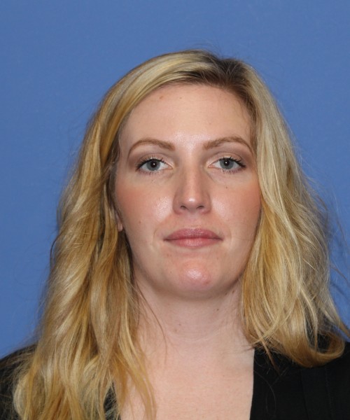 Rhinoplasty 1270 – Click HERE for more views before photo. Individual results may vary.