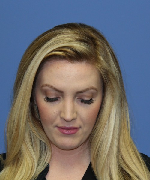 Rhinoplasty 1270 – Click HERE for more views after photo. Individual results may vary.