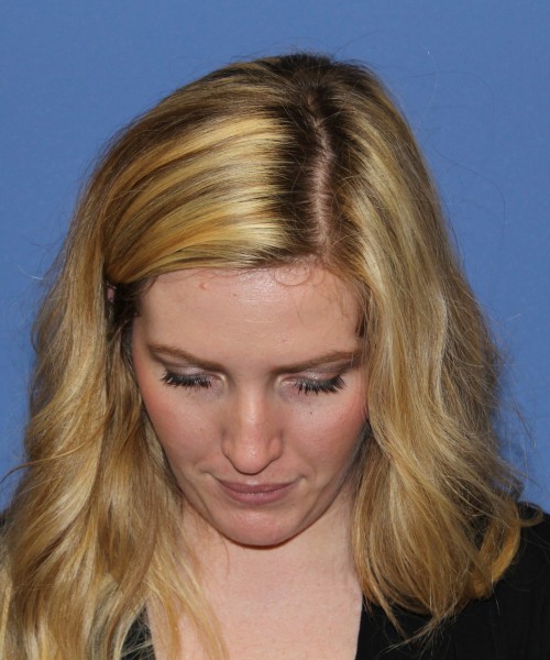 Rhinoplasty 1270 – Click HERE for more views before photo. Individual results may vary.