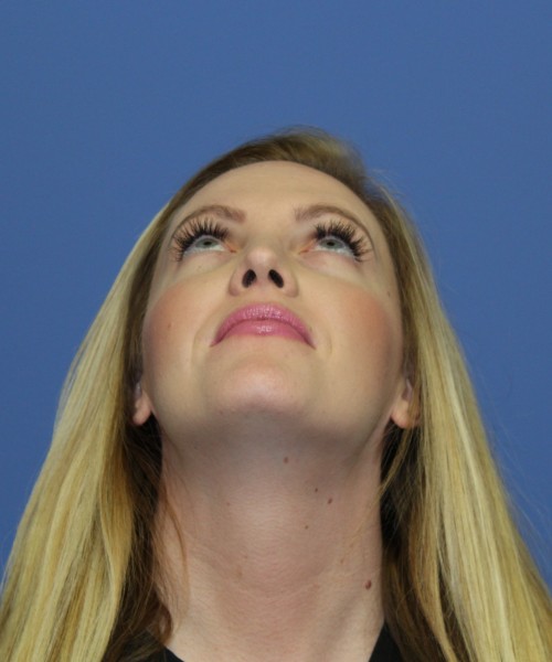 Rhinoplasty 1270 – Click HERE for more views after photo. Individual results may vary.