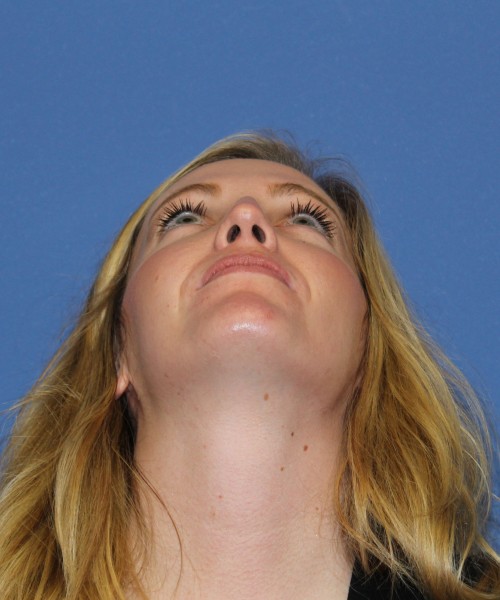 Rhinoplasty 1270 – Click HERE for more views before photo. Individual results may vary.