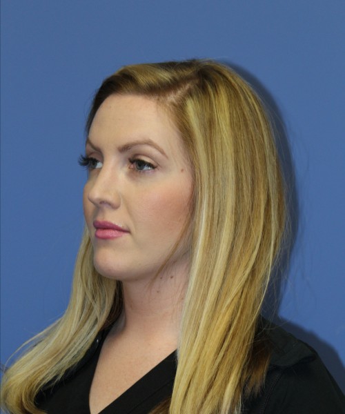 Rhinoplasty 1270 – Click HERE for more views after photo. Individual results may vary.