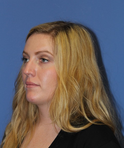 Rhinoplasty 1270 – Click HERE for more views before photo. Individual results may vary.