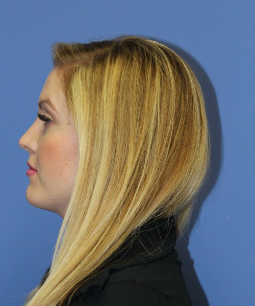 Rhinoplasty 1270 – Click HERE for more views after photo. Individual results may vary.