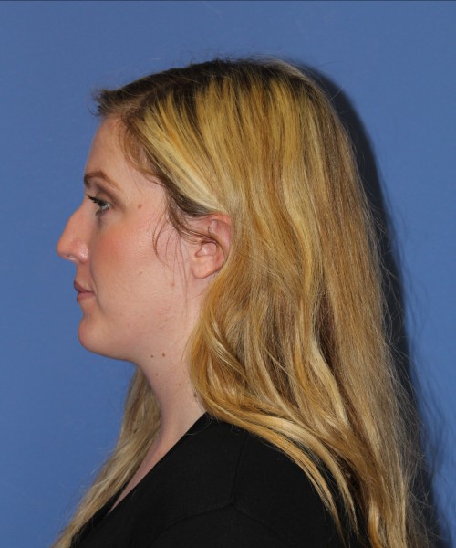 Rhinoplasty 1270 – Click HERE for more views before photo. Individual results may vary.