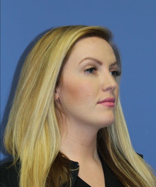 Rhinoplasty 1270 – Click HERE for more views after photo. Individual results may vary.