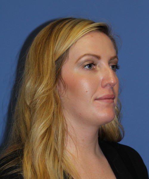 Rhinoplasty 1270 – Click HERE for more views before photo. Individual results may vary.
