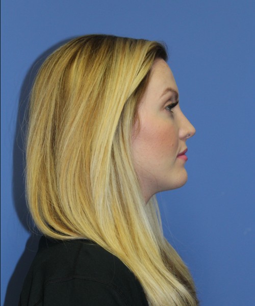 Rhinoplasty 1270 – Click HERE for more views after photo. Individual results may vary.