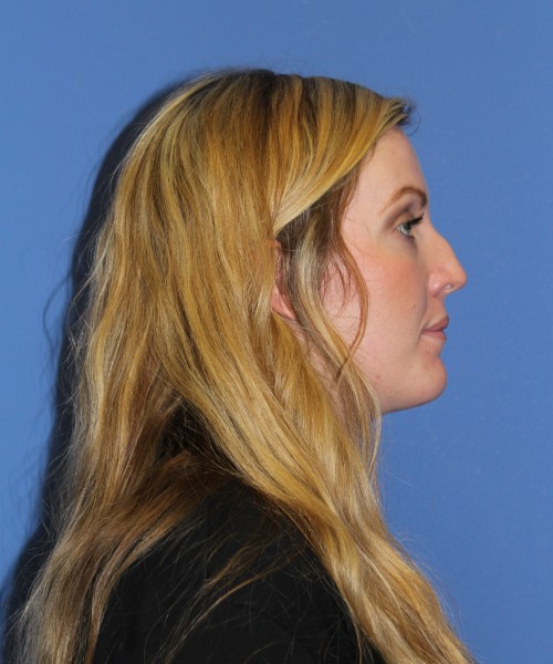 Rhinoplasty 1270 – Click HERE for more views before photo. Individual results may vary.