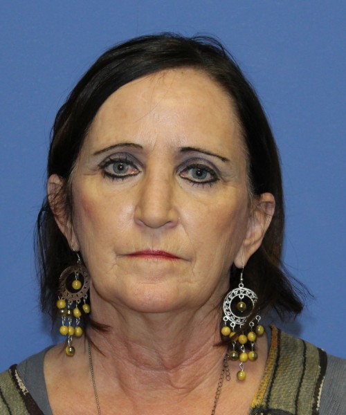Rhinoplasty 1271 – Click HERE for more views after photo. Individual results may vary.
