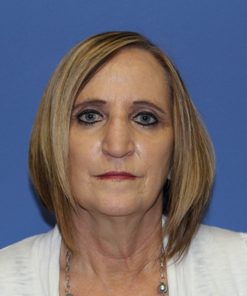 Rhinoplasty 1271 – Click HERE for more views before photo. Individual results may vary.