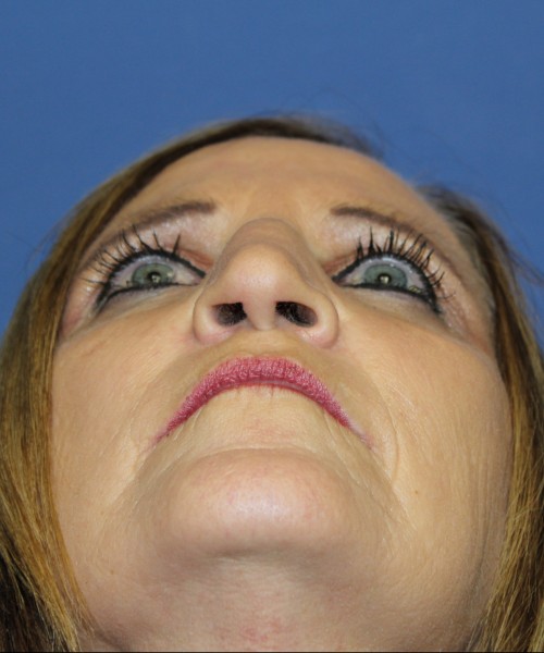 Rhinoplasty 1271 – Click HERE for more views before photo. Individual results may vary.