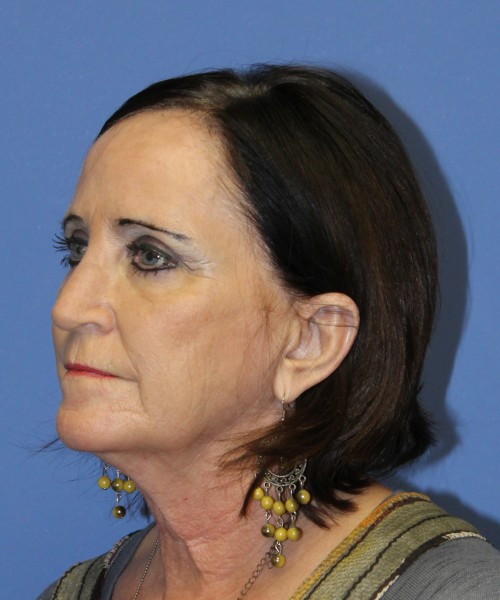 Rhinoplasty 1271 – Click HERE for more views after photo. Individual results may vary.