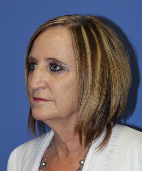Rhinoplasty 1271 – Click HERE for more views before photo. Individual results may vary.
