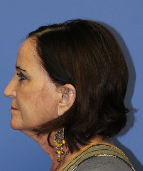 Rhinoplasty 1271 – Click HERE for more views after photo. Individual results may vary.