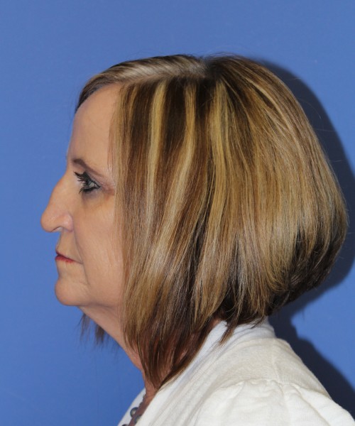 Rhinoplasty 1271 – Click HERE for more views before photo. Individual results may vary.