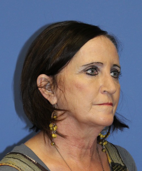 Rhinoplasty 1271 – Click HERE for more views after photo. Individual results may vary.