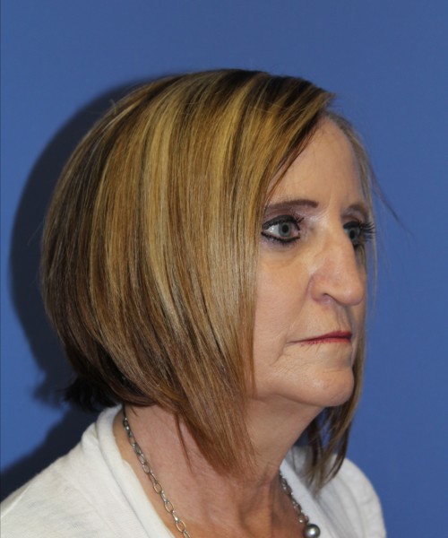 Rhinoplasty 1271 – Click HERE for more views before photo. Individual results may vary.