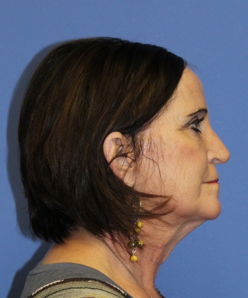 Rhinoplasty 1271 – Click HERE for more views after photo. Individual results may vary.