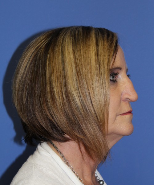 Rhinoplasty 1271 – Click HERE for more views before photo. Individual results may vary.