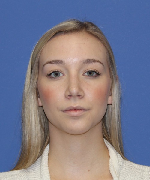 Rhinoplasty 1377 – Click HERE for more views after photo. Individual results may vary.
